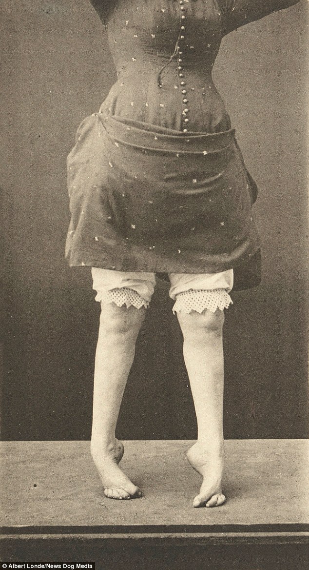 photograph of the bottom half of a woman who is suffering from hysteria at the asylum