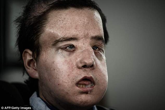 jerome hamon pictured has been dubbed the man with three faces after becoming the first person to receive two face transplants he now says he is getting used to his new identity
