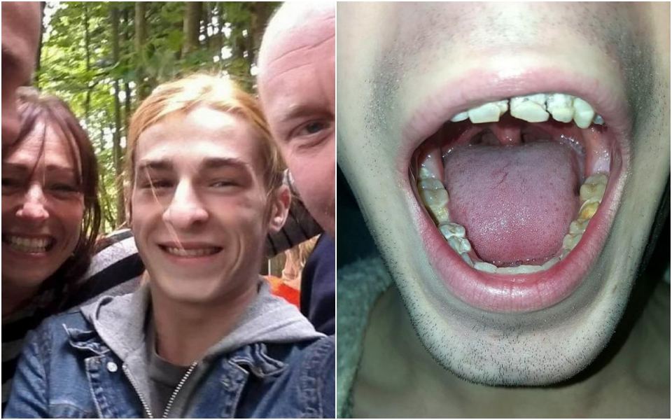 Chàng trai gãy liền bốn chiếc răng sau 7 tháng uống hàng trăm lon nước tăng lực