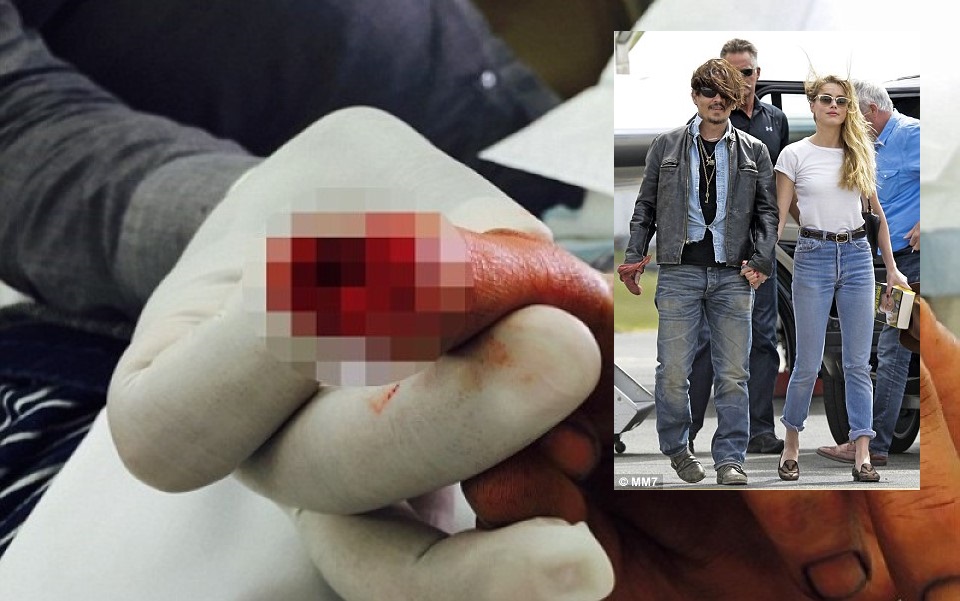 Johnny Depp đưa ra bằng chứng Amber Heard đã chém đứt một phần ngón tay anh khi cãi nhau