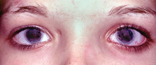abnormal pupils and iridal hypoplasia with the rieger syndrome case 4