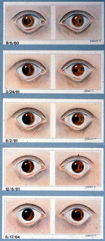 progressive iris changes in riegers 2