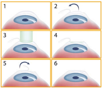 relex smile laser eye treatment femto lasik