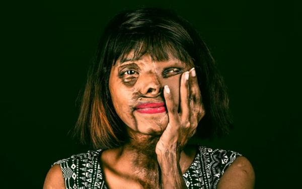 0 pay happiest acid attack survivor 1