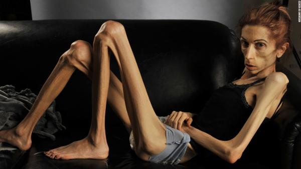 inilah perubahan drastis model seksi yang menderita anoreksia ae9db7