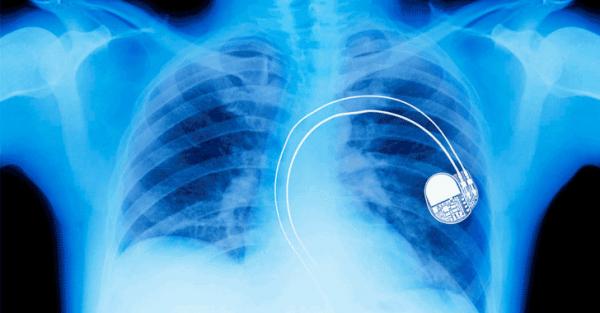 pacemakers hacking