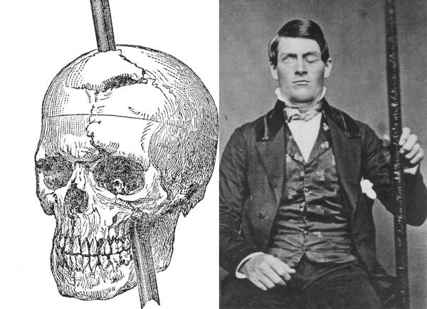 phineas gage with skull picture