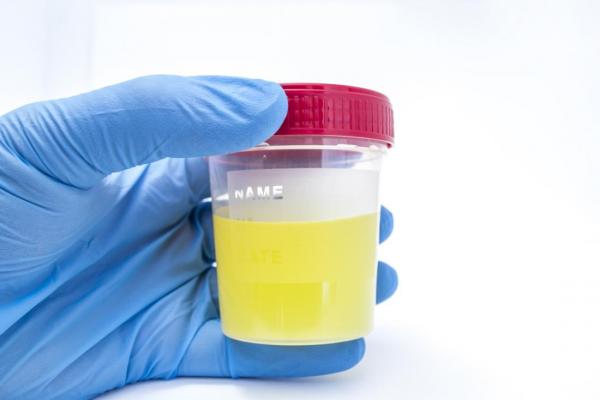 urine sample to determine why urine smells like fish