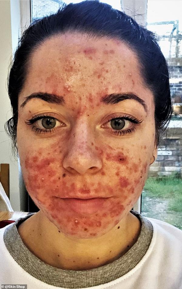 9119270 7384091 emily suffered with angry cystic acne which was very painful and a 61 1566487809993