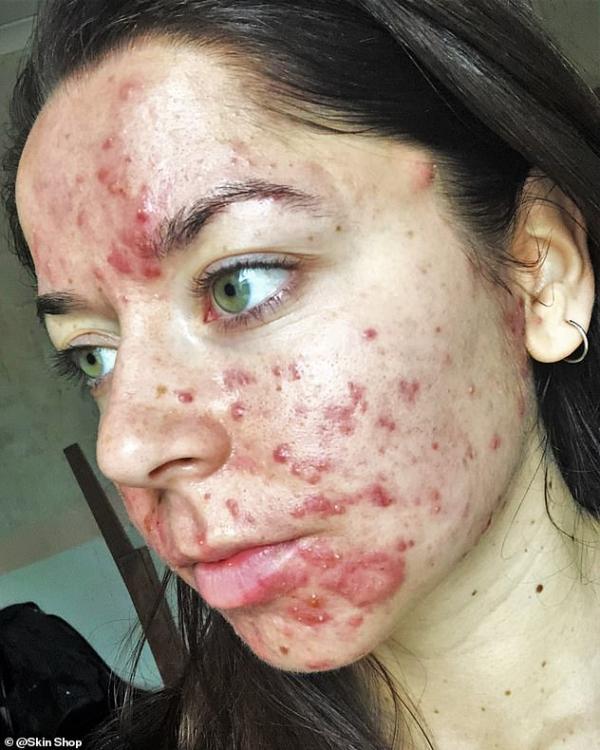 9119272 7384091 emily claimed doctors were insensitive regarding her skin condit a 62 1566487841705