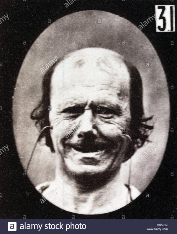 the facial expression of false laughter on the human face being induced by electrical currents guillaume benjamin amand duchenne de boulogne september 17 1806 september 15 1875 was a french neurologis